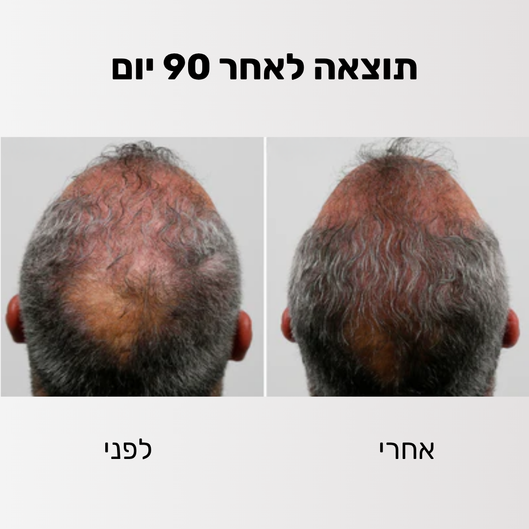 Glider - ערכה לטיפול ושיקום נשירת השיער