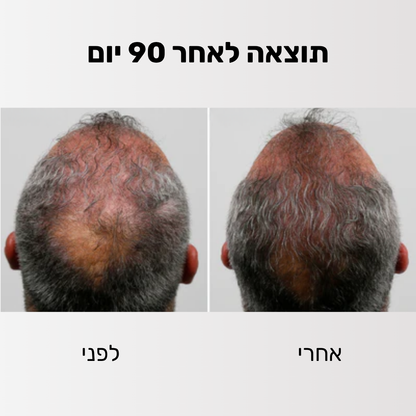 Glider - ערכה לטיפול ושיקום נשירת השיער