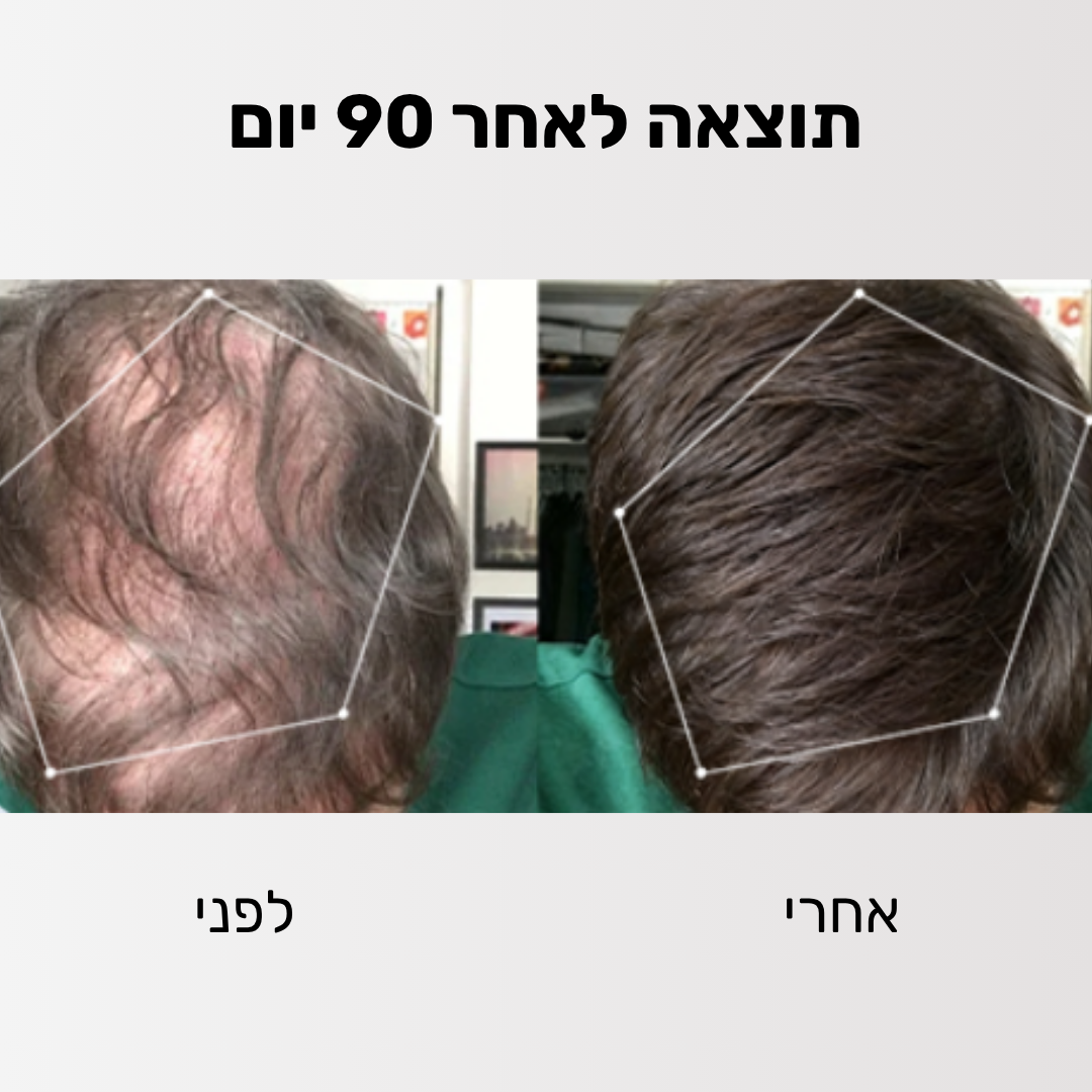 Glider - ערכה לטיפול ושיקום נשירת השיער