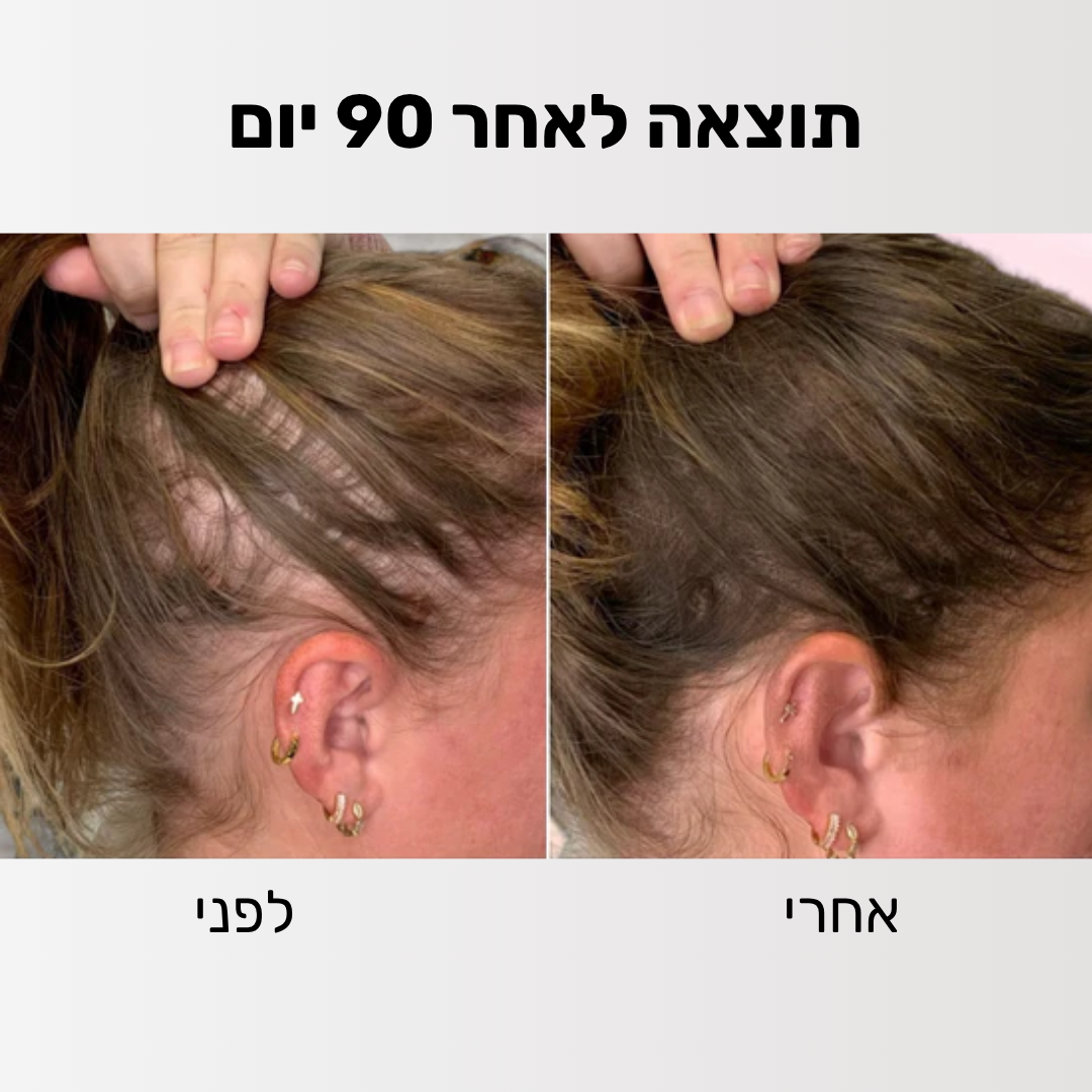 Glider - ערכה לטיפול ושיקום נשירת השיער